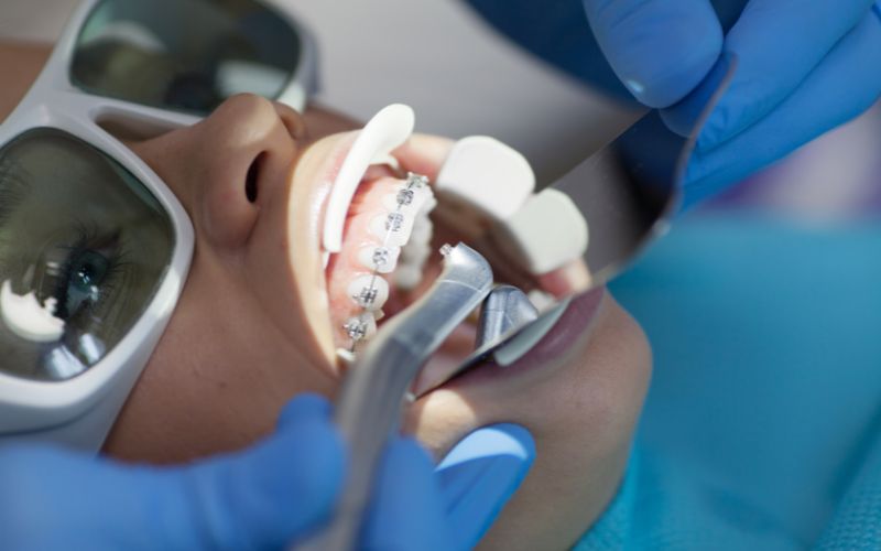 A child is getting braces in a dentist's office aided by a Photon Soft Tissue Diode Laser.