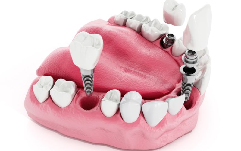 A tooth model featuring dental implants.