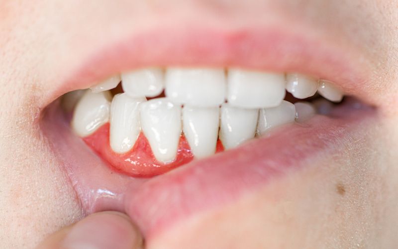 A close up of a person's mouth dispelling a dental myth.
