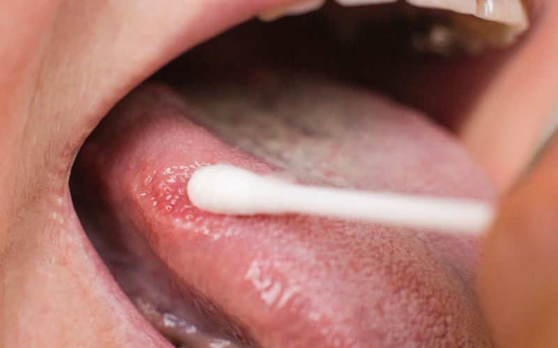 A close up of a person's tongue with a toothbrush, emphasizing oral cancer