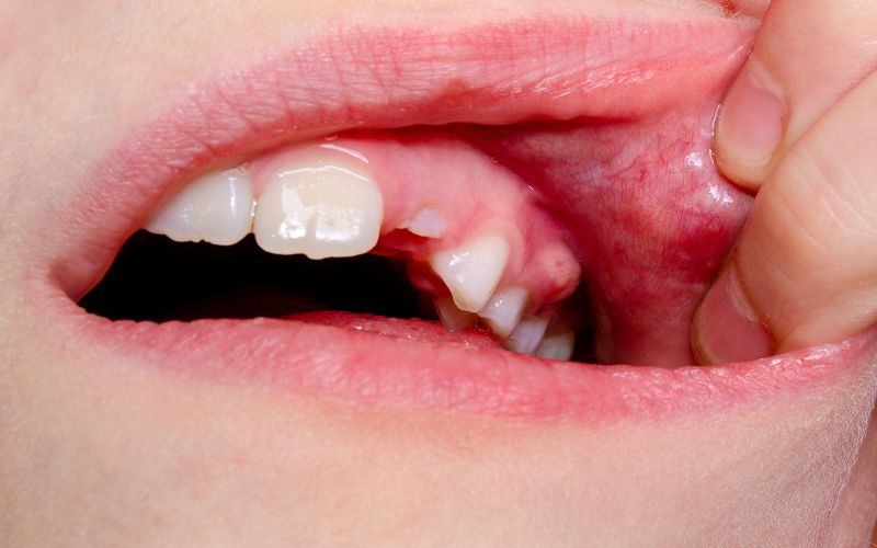 A close up of a person's mouth with gum disease.