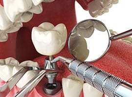 dental implants image from emergency dental in hamilton