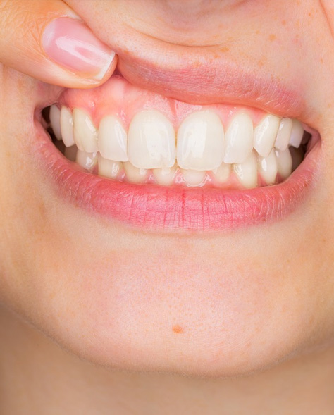 Young woman lifting top lip to show gum inflammation in gum bone hamilton