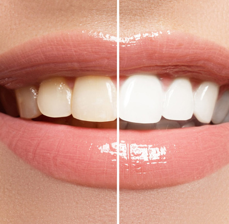 Before and after comparison of teeth given teeth whitening treatment in teeth whitening hamilton