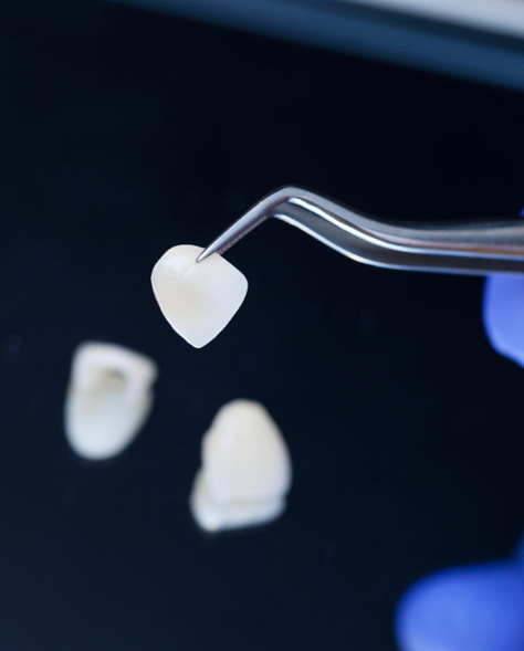 Close-up of porcelain dental veneer at emergency dental in hamilton