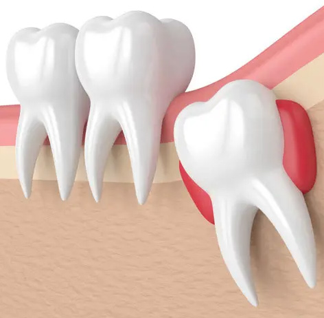 Digital graphic of impacted wisdom tooth about to grow in hamilton dentistry