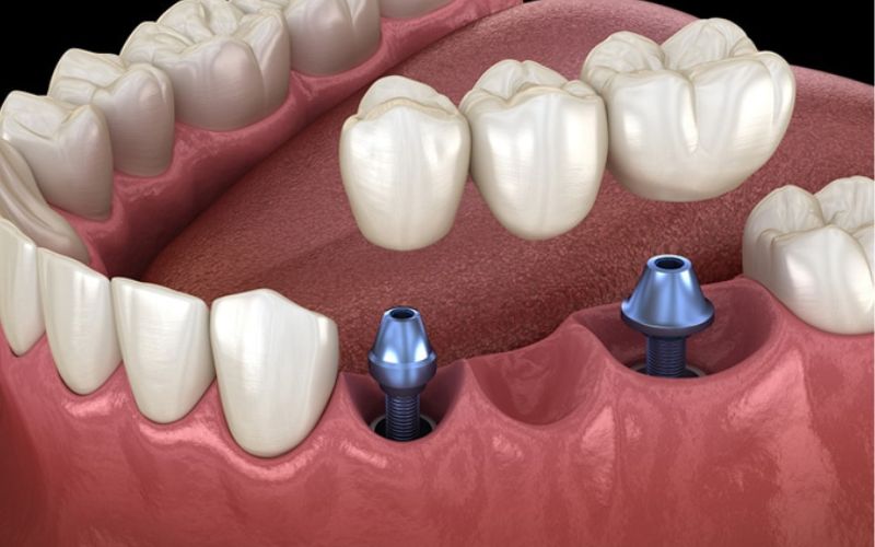 dental bridge from dental implant hamilton