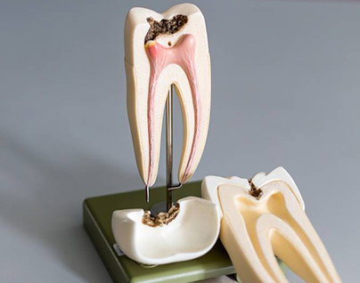 Cross-section of model tooth requiring root canal therapy at emergency dental in hamilton