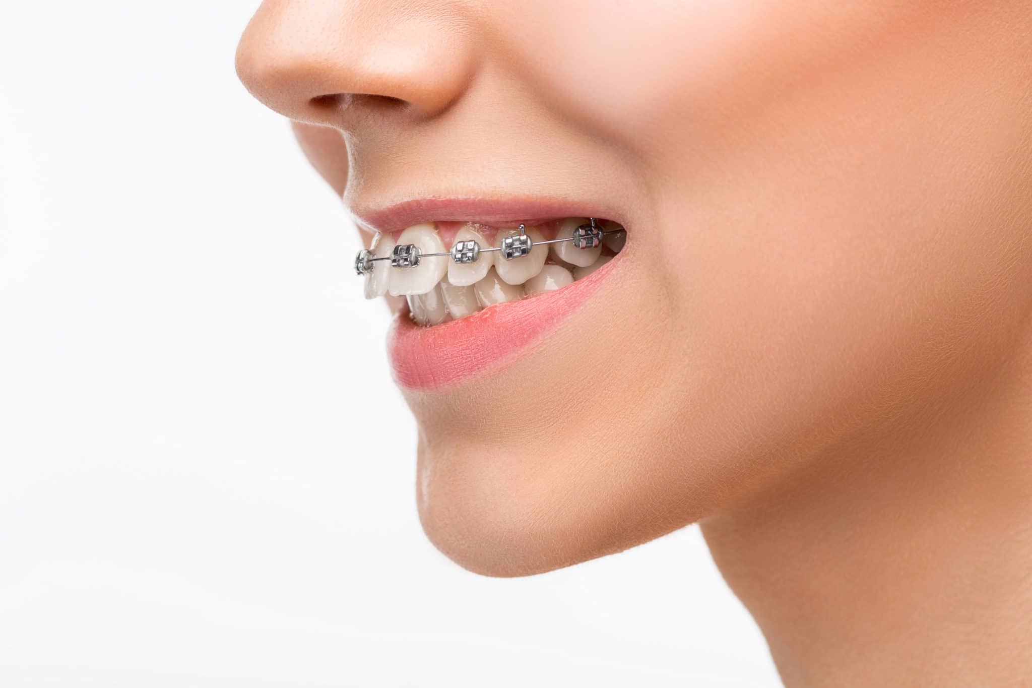 Close-up of young woman with traditional metal braces in hamilton