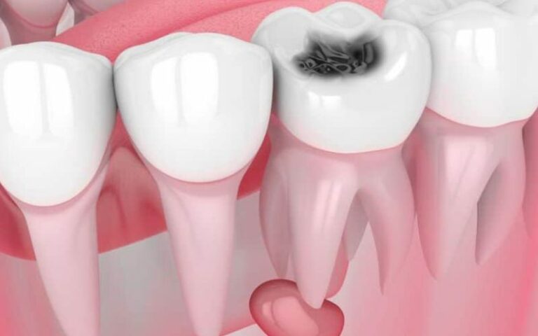 signs of a tooth infection