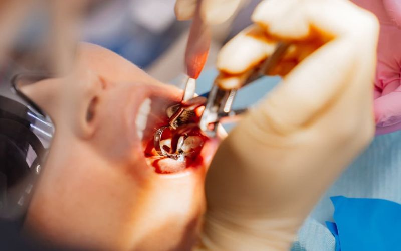 real dentist pulls out a sick wisdom tooth
