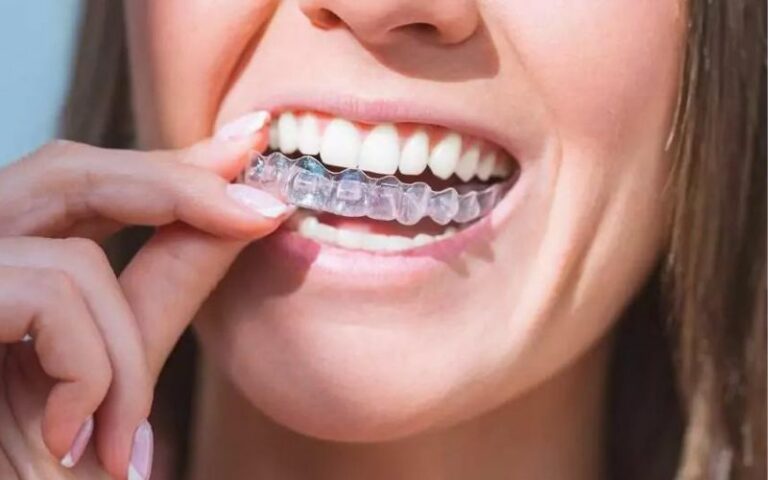 Woman with perfect smile wearing invisible dental aligners for dental correction