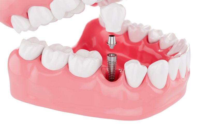 Process Implants teeth health care on white background