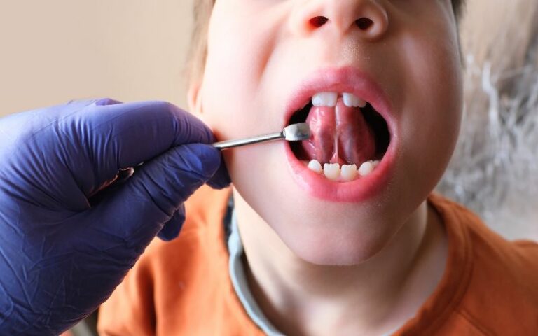 A child's mouth being examined by a dentist for tongue tie.