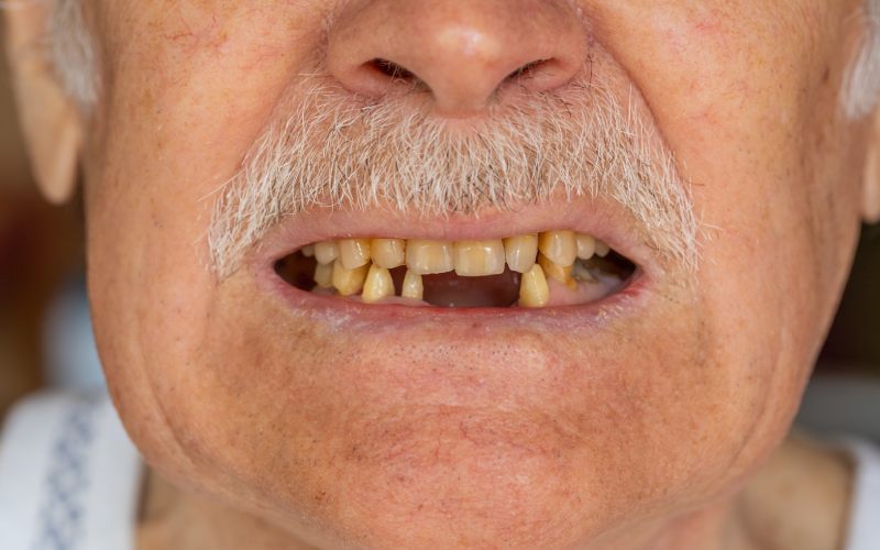 A close up of an old man with teeth missing.