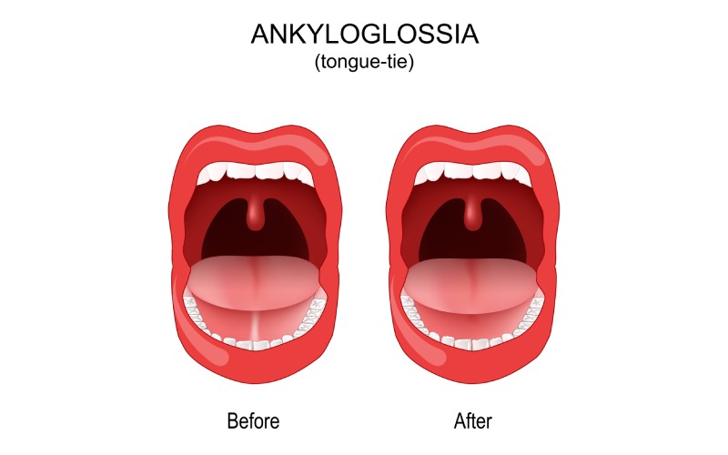 Ankyloglossia before and after illustration.