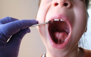 A dentist in gloves examines a child’s open mouth using a dental mirror.
