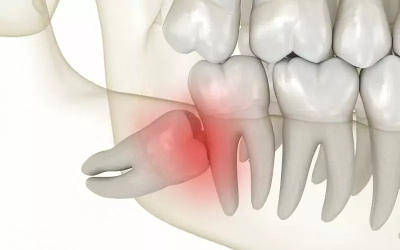 An image of a tooth with a red spot indicating wisdom teeth pain.