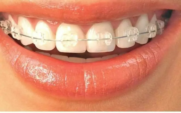 Invisible Braces