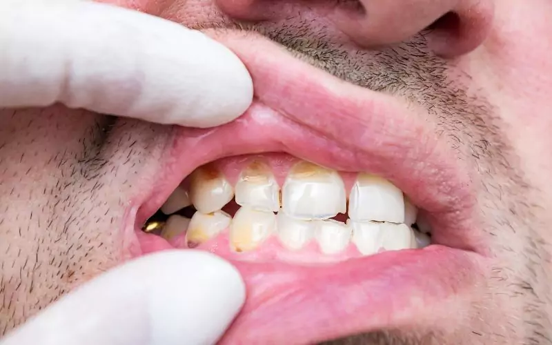 A dental hygienist examines a man's tooth enamel.