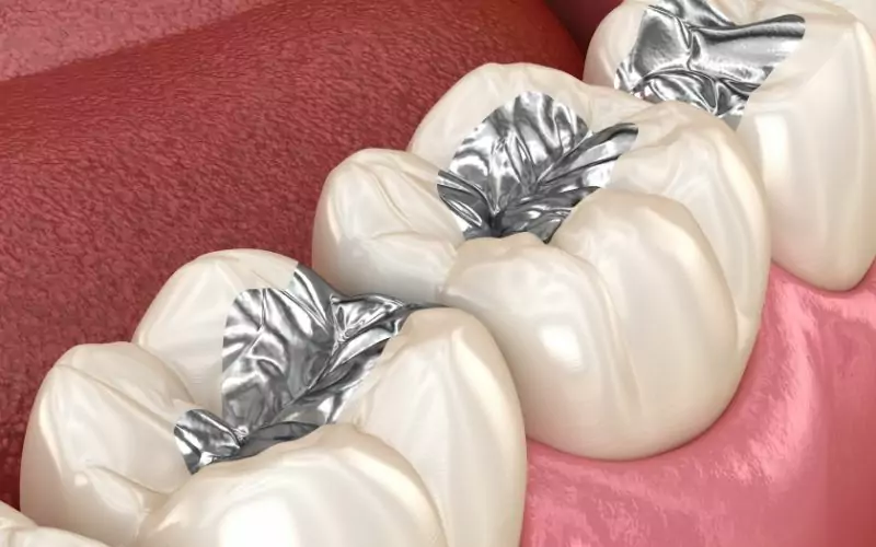 A close up of a tooth with silver fillings, highlighting silver fillings.