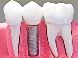 dental implant hamilton