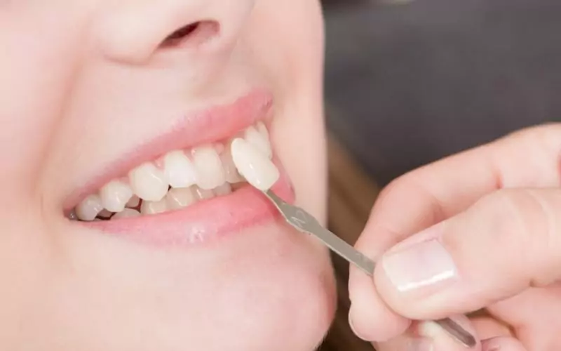 Benefits Of Choosing Century Stone For Same-Day Dental Crowns & Bridges