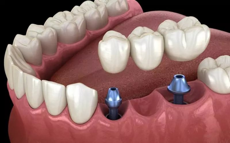 Choosing Century Stone For Same-Day Dental Crowns & Bridges