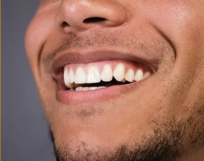 Young man smiling with bright white fillings in cosmetic dentist hamilton