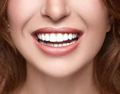 Bright smile with stunning porcelain veneers at dental office in hamilton
