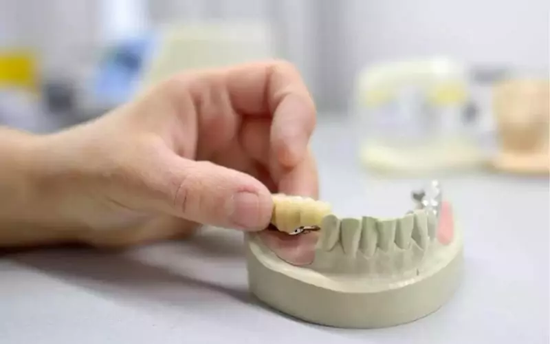 Will Dental Insurance Cover Crown Replacement?