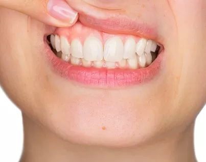 Young woman lifting top lip to show gum inflammation in gum graft surgery