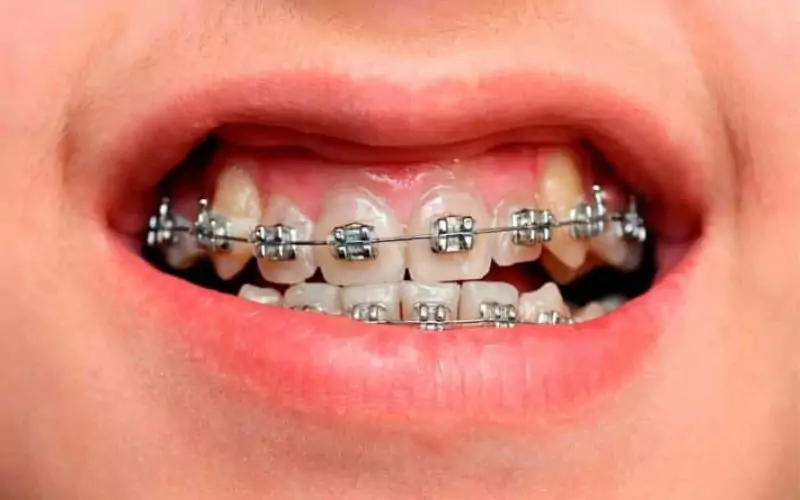 How Often To Visit The Dentist With Braces