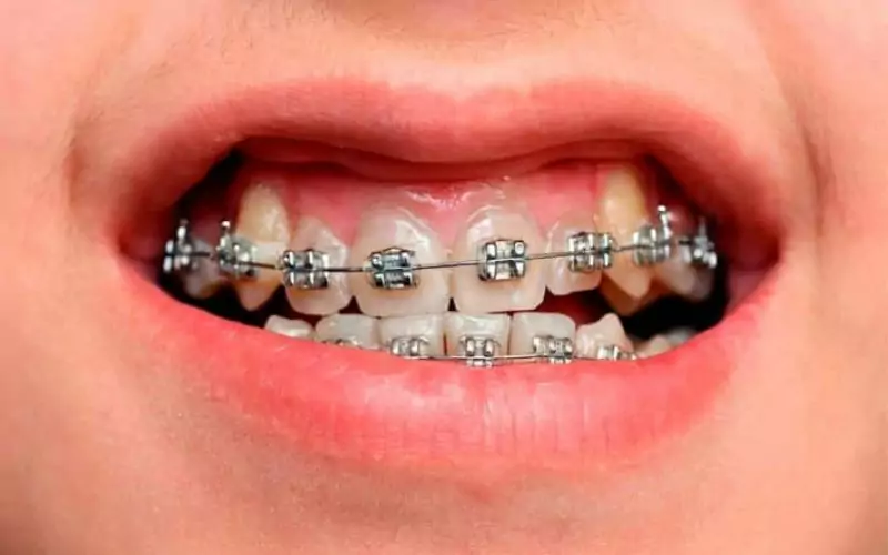 https://centurystonedental.com/wp-content/webp-express/webp-images/uploads/2022/05/How-Often-To-Visit-The-Dentist-With-Braces.jpg.webp