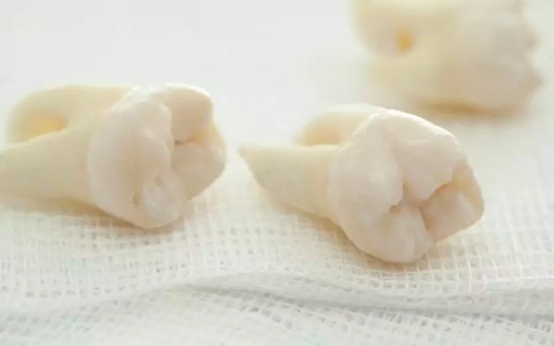 Impacted Wisdom Teeth