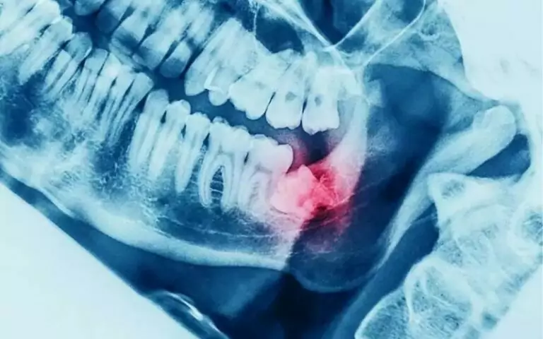 when can i eat after wisdom teeth removal