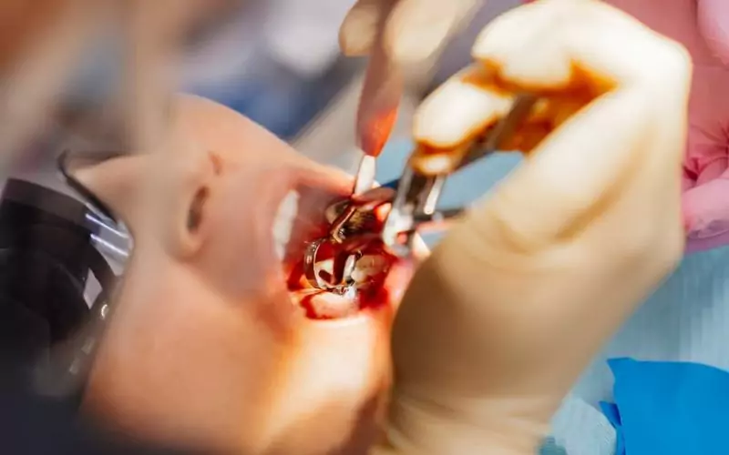 real dentist pulls out a sick wisdom tooth