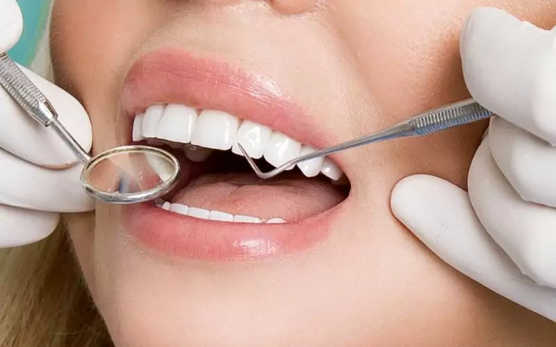 porcelain veneers on a patient used to improve look of teeth