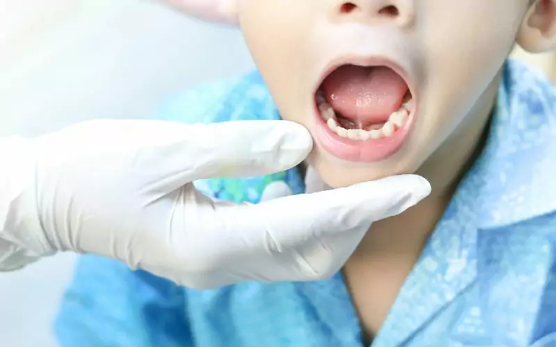 A child's tongue tie being examined by a dentist.