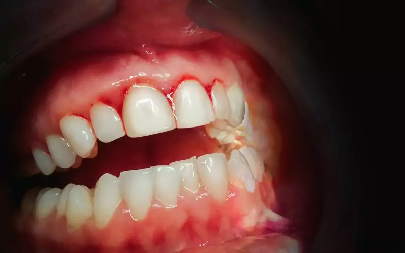 Mouth with bleeding gums 